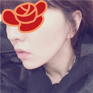 北京南加安棟顯給我做的自體脂肪去法令紋，果很好~